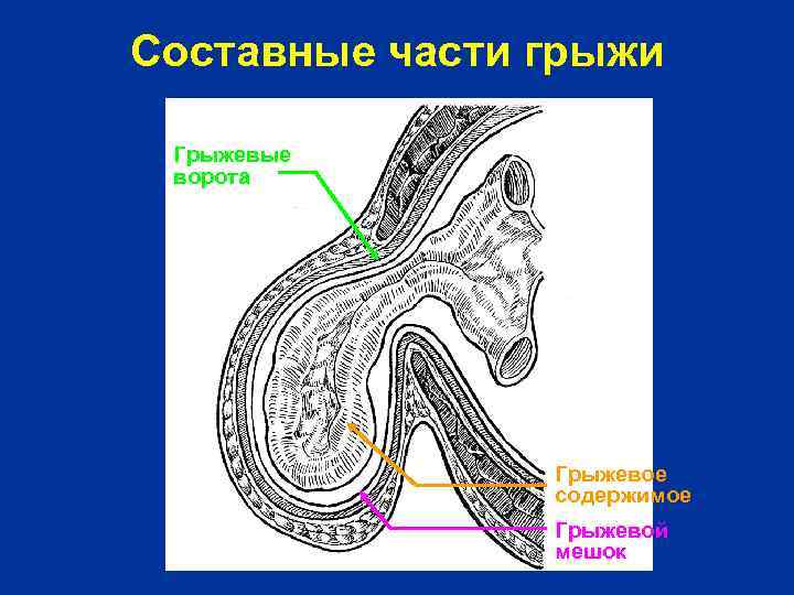 Составные части грыжи Грыжевые ворота Грыжевое содержимое Грыжевой мешок 