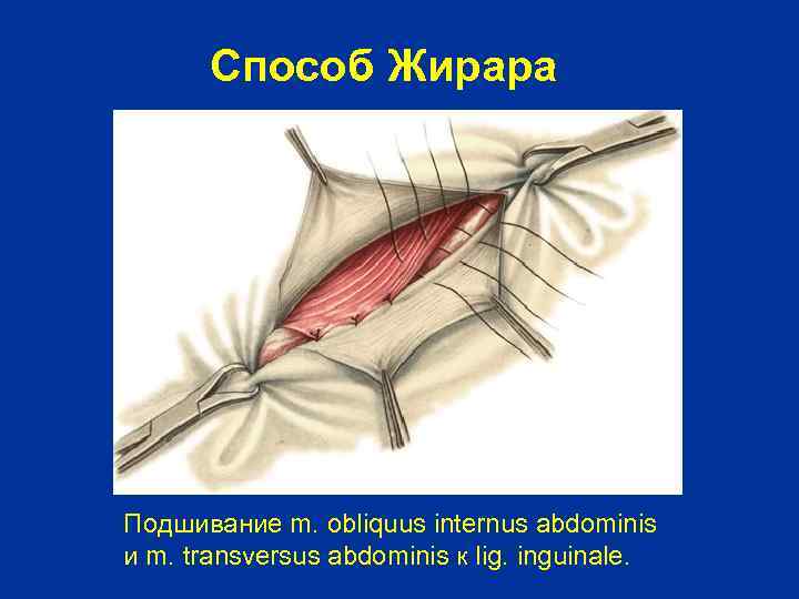 Способ Жирара Подшивание m. obliquus internus abdominis и m. transversus abdominis к lig. inguinale.