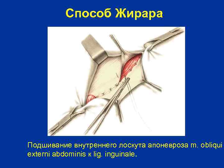 Способ Жирара Подшивание внутреннего лоскута апоневроза m. obliqui externi abdominis к lig. inguinale. 