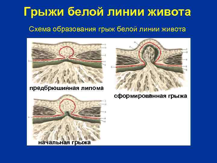 Грыжи белой линии живота Схема образования грыж белой линии живота предбрюшинная липома сформированная грыжа