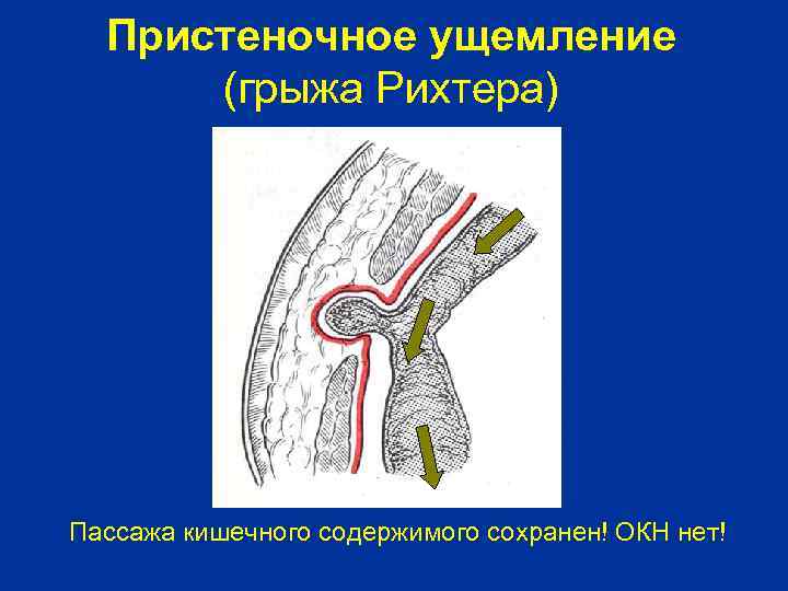 Пристеночное ущемление (грыжа Рихтера) Пассажа кишечного содержимого сохранен! ОКН нет! 