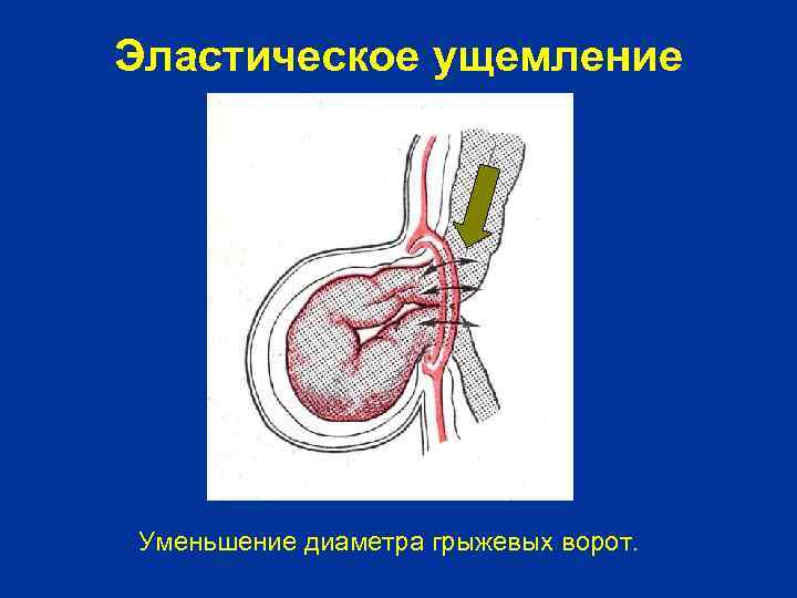 Эластическое ущемление Уменьшение диаметра грыжевых ворот. 