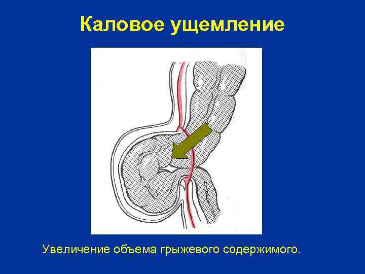 Каловое ущемление Увеличение объема грыжевого содержимого. 