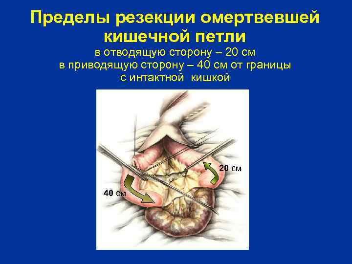 Пределы резекции омертвевшей кишечной петли в отводящую сторону – 20 см в приводящую сторону