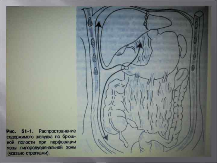 Содержимое желудка. Симптомы при перфорации желудка. Перфорация желудка схема. Перфорация язвы желудка задней стенки.