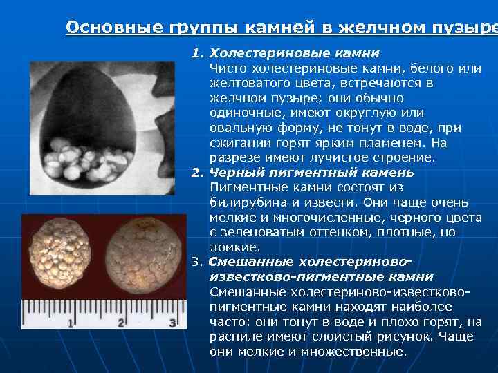 Основные группы камней в желчном пузыре 1. Холестериновые камни Чисто холестериновые камни, белого или