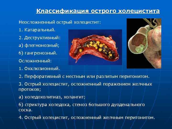 Классификация острого холецистита Неосложненный острый холецистит: 1. Катаральный. 2. Деструктивный: а) флегмонозный; б) гангренозный.