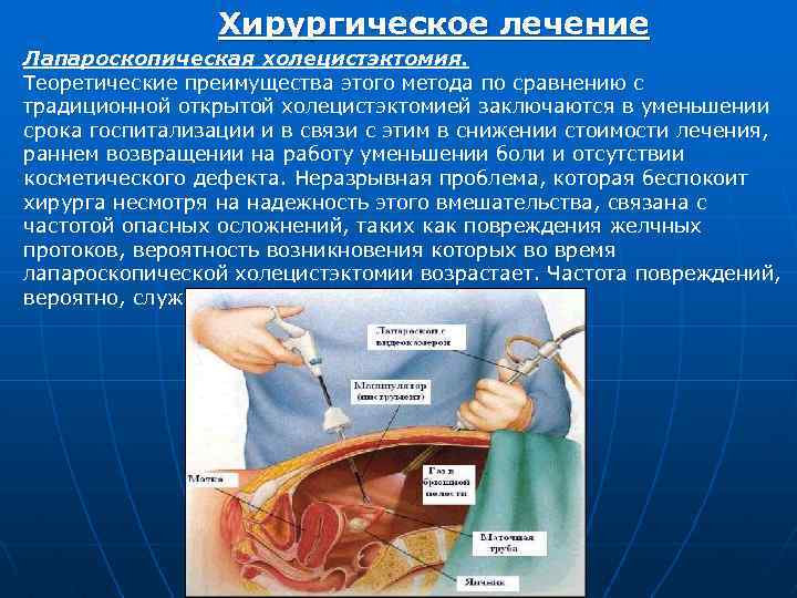 Хирургическое лечение Лапароскопическая холецистэктомия. Теоретические преимущества этого метода по сравнению с традиционной открытой холецистэктомией