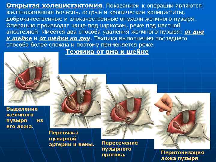 Открытая холецистэктомия. Показанием к операции являются: желчнокаменная болезнь, острые и хронические холециститы, доброкачественные и