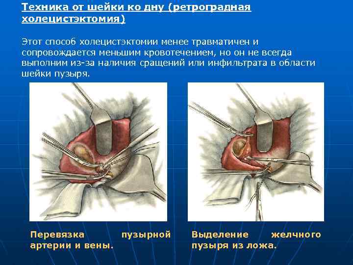 Техника от шейки ко дну (ретроградная холецистэктомия) Этот способ холецистэктомии менее травматичен и сопровождается