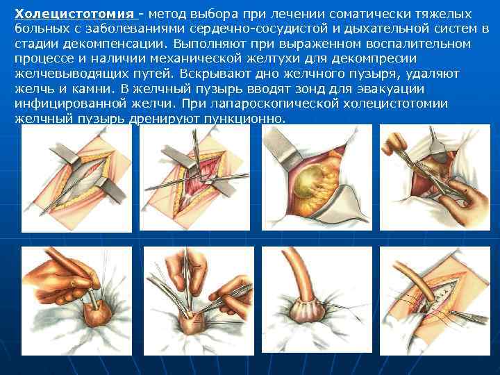 Холецистотомия - метод выбора при лечении соматически тяжелых больных с заболеваниями сердечно-сосудистой и дыхательной