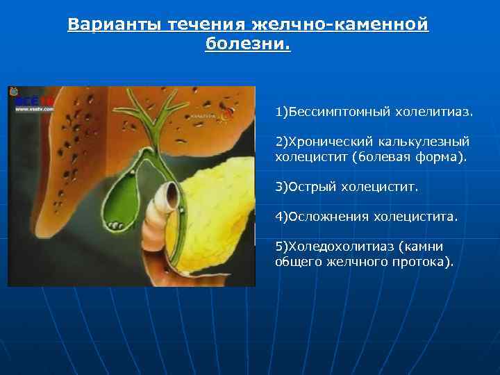 Варианты течения желчно каменной болезни. 1)Бессимптомный холелитиаз. 2)Хронический калькулезный холецистит (болевая форма). 3)Острый холецистит.