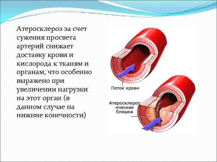 Атеросклероз за счет сужения просвета артерий снижает доставку крови и кислорода к тканям и