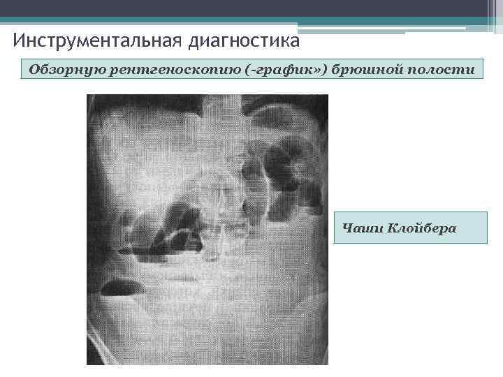 Инструментальная диагностика Обзорную рентгеноскопию (-график» ) брюшной полости Чаши Клойбера 