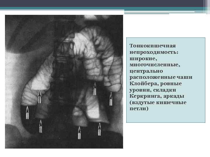 Тонкокишечная непроходимость: широкие, многочисленные, центрально расположенные чаши Клойбера, ровные уровни, складки Керкринга, аркады (вздутые