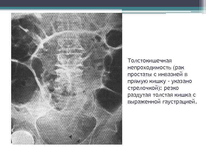 Пневматизация кишечника на узи