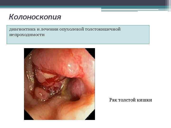 Колоноскопия диагностика и лечении опухолевой толстокишечной непроходимости Рак толстой кишки 