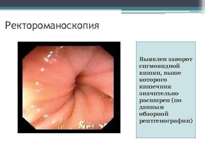 Ректороманоскопия Выявлен заворот сигмовидной кишки, выше которого кишечник значительно расширен (по данным обзорной рентгенографии)