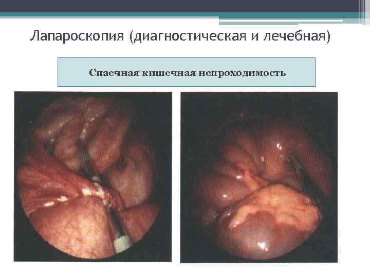 Лапароскопия (диагностическая и лечебная) Спаечная кишечная непроходимость 