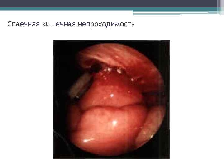 Спаечная кишечная непроходимость 