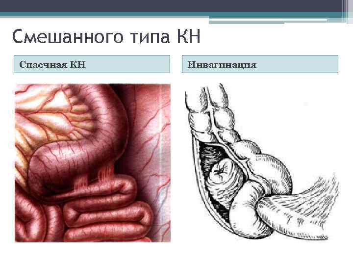 Смешанного типа КН Спаечная КН Инвагинация 