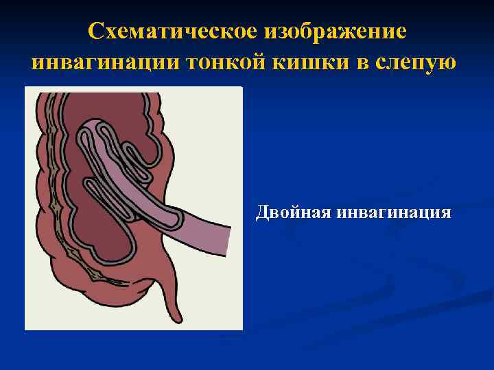 Схематическое изображение инвагинации тонкой кишки в слепую Двойная инвагинация 