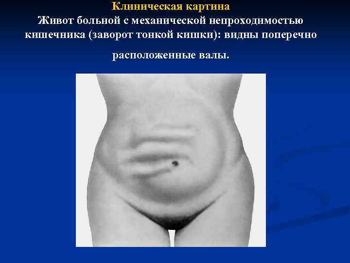 Клиническая картина Живот больной с механической непроходимостью кишечника (заворот тонкой кишки): видны поперечно расположенные