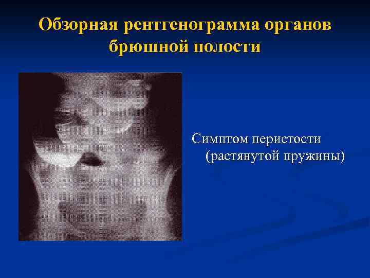 Обзорная рентгенограмма органов брюшной полости Симптом перистости (растянутой пружины) 
