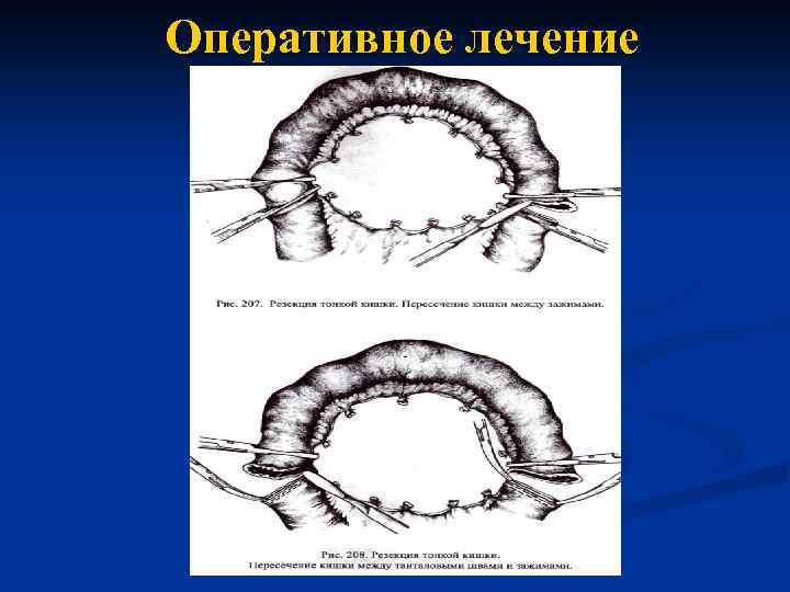 Оперативное лечение 