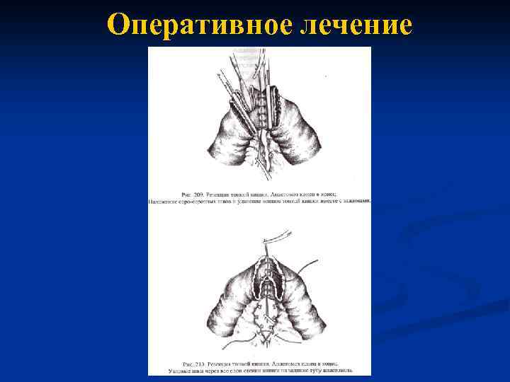 Оперативное лечение 