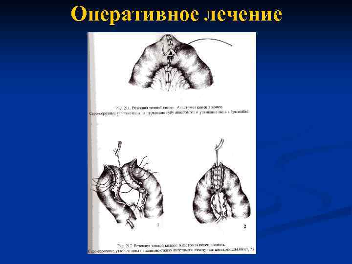 Оперативное лечение 