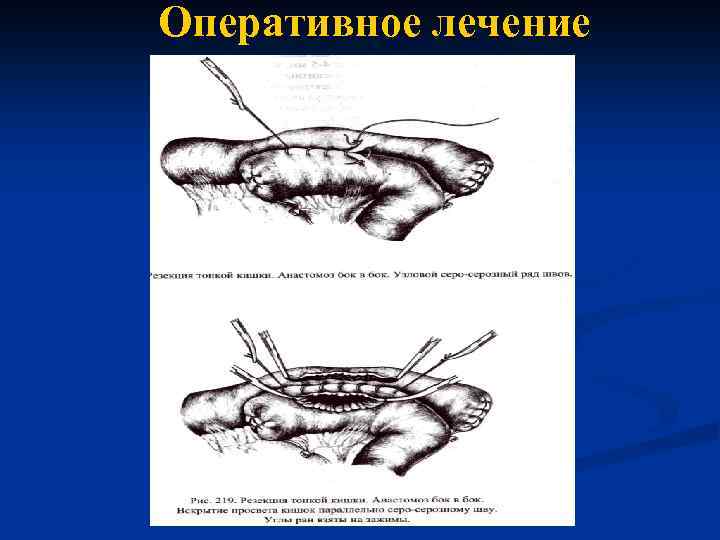 Оперативное лечение 