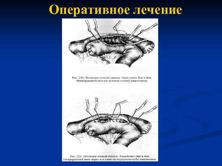 Оперативное лечение 