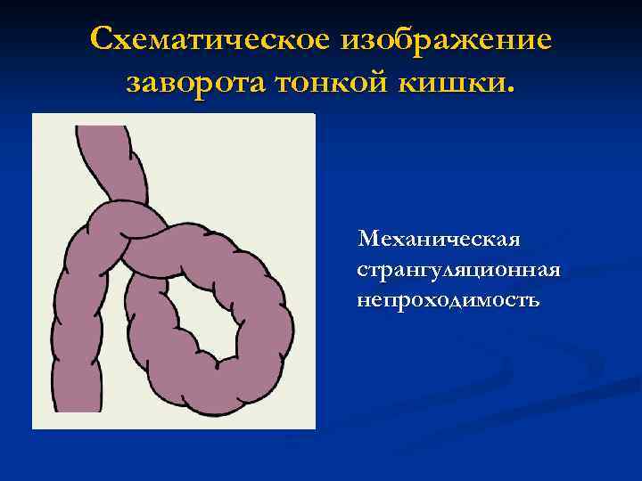 Схематическое изображение заворота тонкой кишки. Механическая странгуляционная непроходимость 