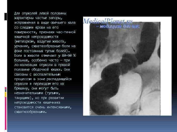 Для опухолей левой половины характерны частые запоры, испражнения в виде овечьего кала со следами
