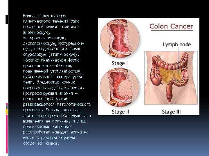 Выделяют шесть форм клинического течения рака ободочной кишки: токсико анемическую, энтероколитическую, диспепсическую, обтурацион ную,