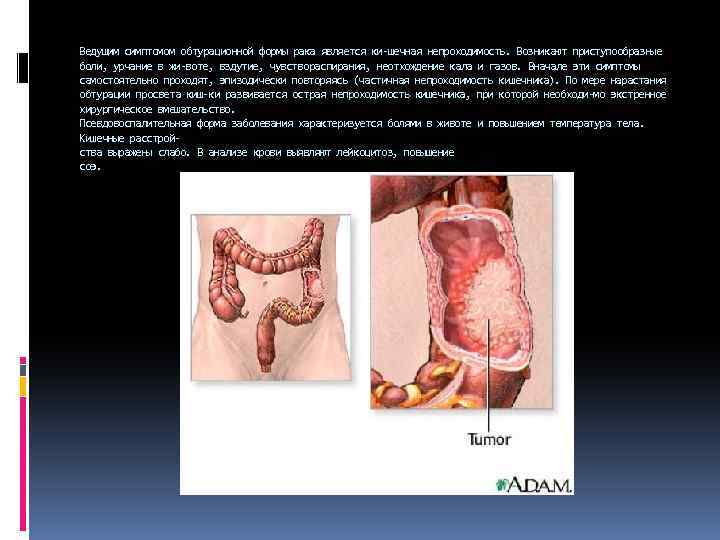 Ведущим симптомом обтурационной формы рака является ки шечная непроходимость. Возникают приступообразные боли, урчание в