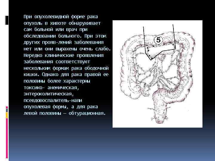 При опухолевидной форме рака опухоль в животе обнаруживает сам больной или врач при обследовании