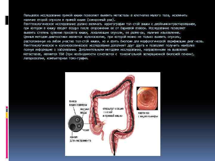 Пальцевое исследование прямой кишки позволяет выявить метастазы в клетчатке малого таза, исключить наличие второй