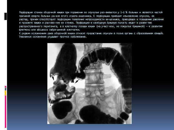 Перфорация стенки ободочной кишки при поражении ее опухолью раз вивается у 1— 2 %
