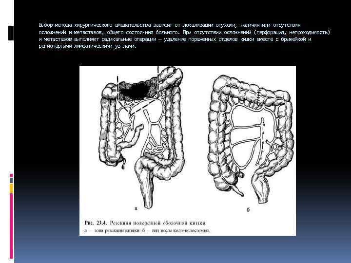 Выбор метода осложнений и и метастазов регионарными хирургического вмешательства зависит от локализации опухоли, наличия