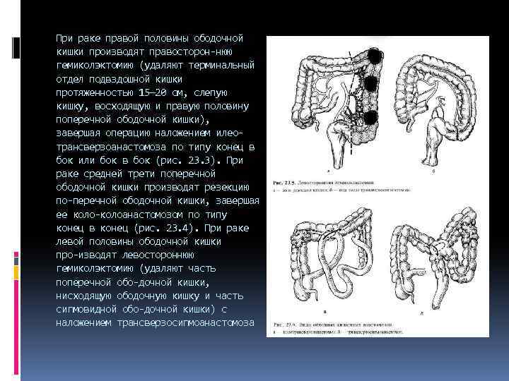 При раке правой половины ободочной кишки производят правосторон нюю гемиколэктомию (удаляют терминальный отдел подвздошной