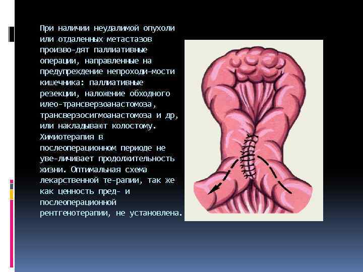 При наличии неудалимой опухоли или отдаленных метастазов произво дят паллиативные операции, направленные на предупреждение