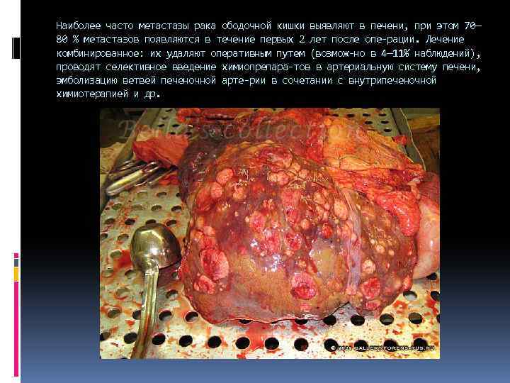 Наиболее часто метастазы рака ободочной кишки выявляют в печени, при этом 70— 80 %