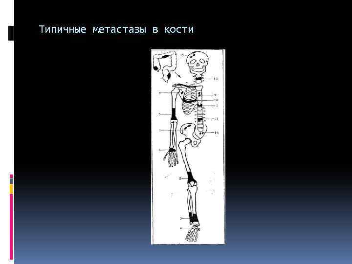 Типичные метастазы в кости 