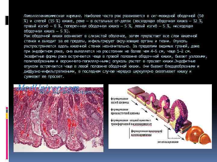 Патологоанатоммеская картина. Наиболее часто рак развивается в сиг мовидной ободочной (50 %) и слепой