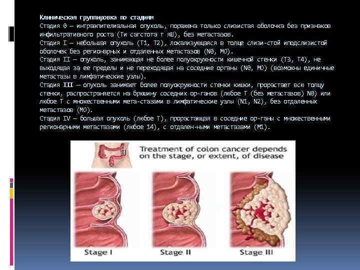 Клиническая группировка по стадиям Стадия 0 — интраэпителиальная опухоль, поражена только слизистая оболочка без