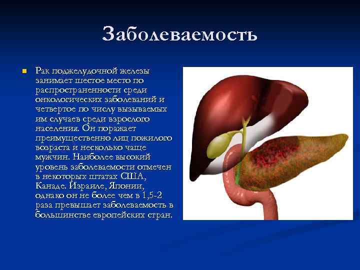 Заболеваемость n Рак поджелудочной железы занимает шестое место по распространенности среди онкологических заболеваний и