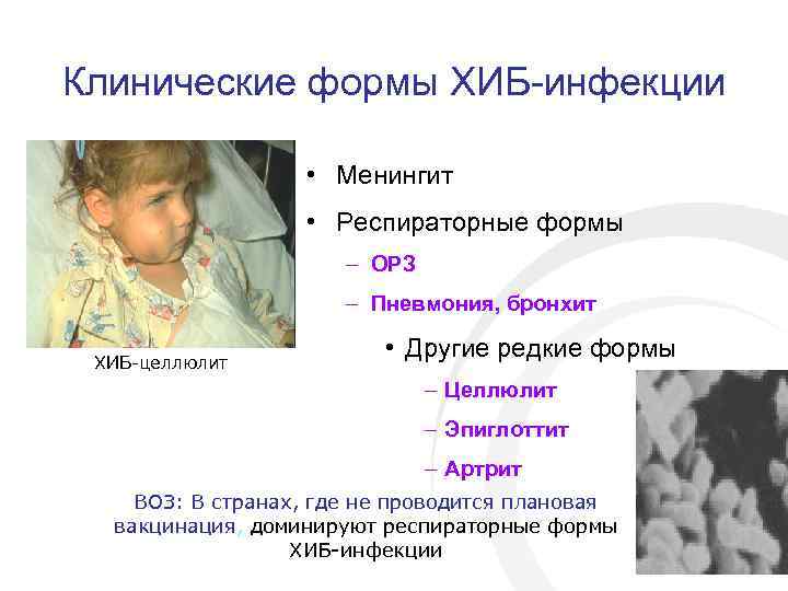 Клинические формы ХИБ-инфекции • Менингит • Респираторные формы – ОРЗ – Пневмония, бронхит ХИБ-целлюлит