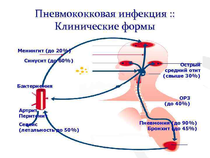 Пневмококковая инфекция : : Клинические формы Менингит (до 20%) Синусит (до 60%) Острый средний